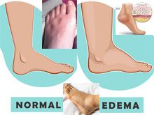 《自然療法與你》- EP679 - 「腳腫」的同類療法